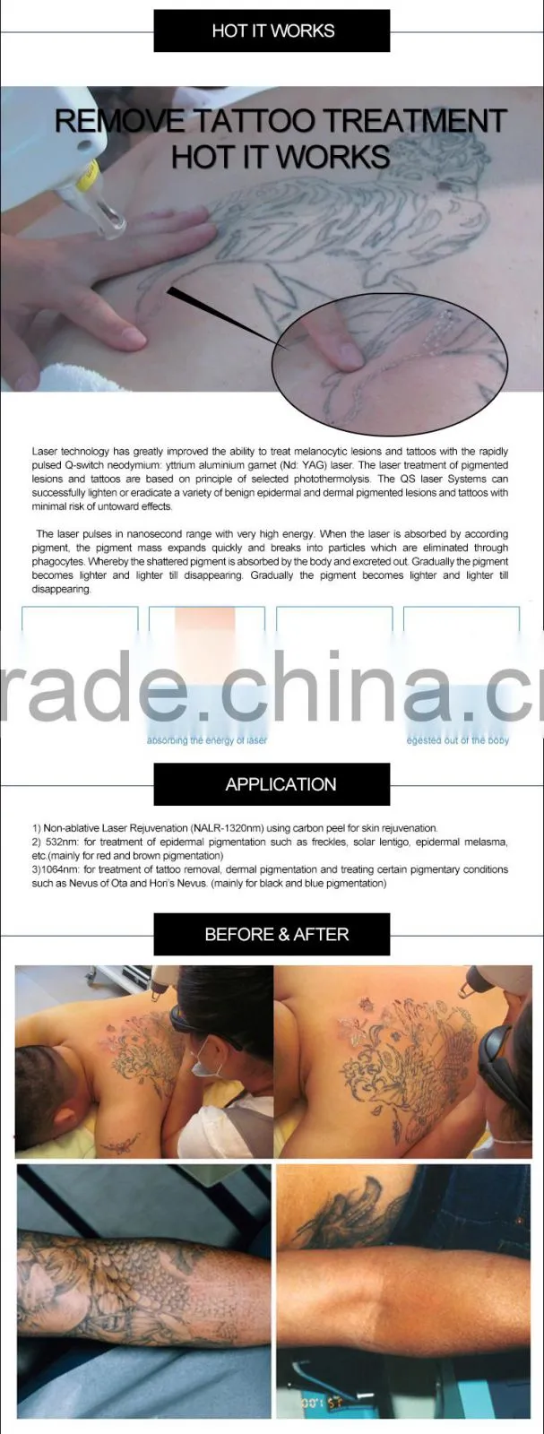 beauty machine nd.yag long pulsed laser tattoo removal with medical CE