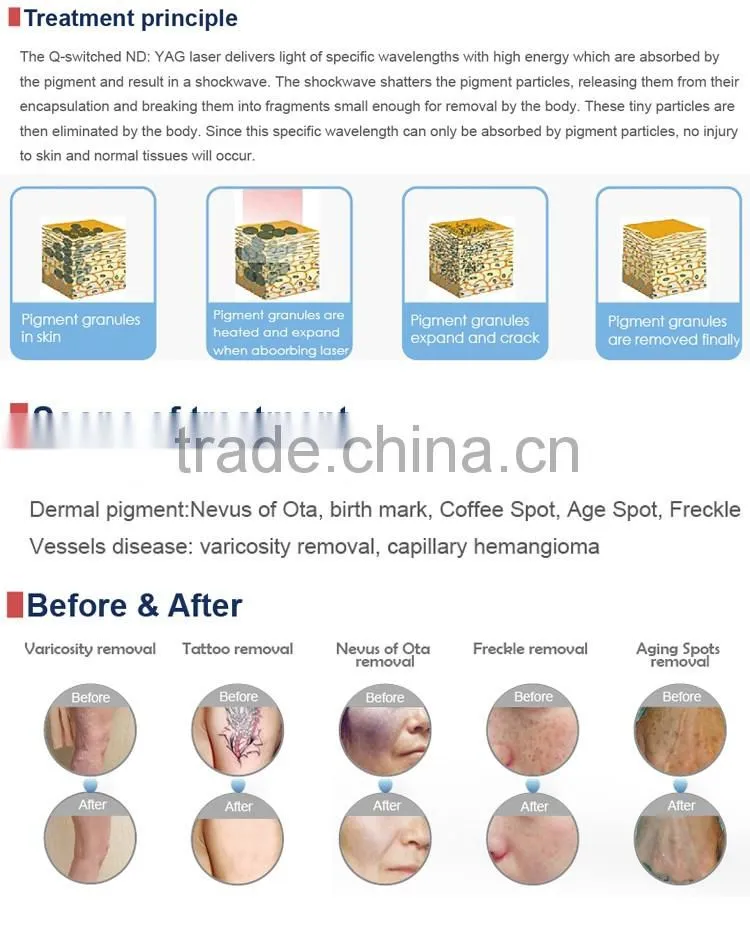 1064 nm / 532nm OEM / ODM varicose veins laser treatment laser tattoo removal equipment