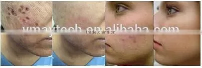 professional fractional co2 laser vagina co2 fractional laser VH613