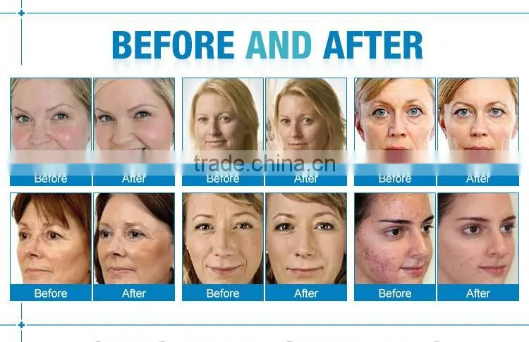 NL-OXY500 multifunction 5 in 1 oxygen peel facial therapy wrinkle removal skin rejuvenation