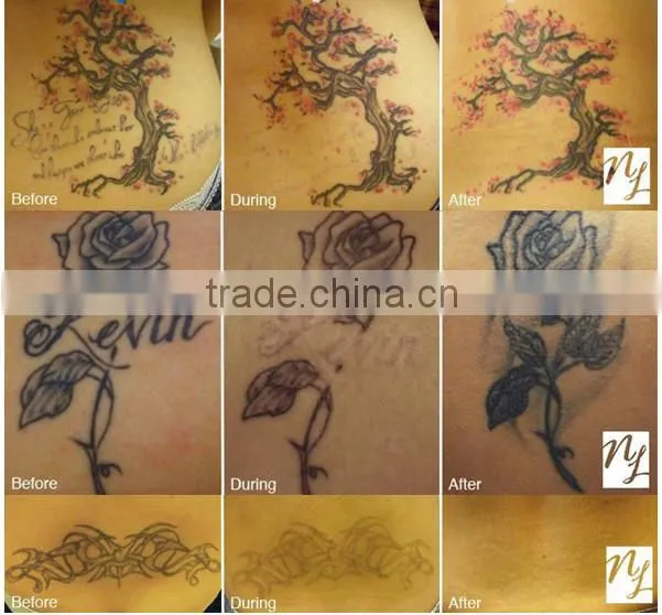 ce approved medical 1064/532nm photoelectric q switch nd yag tattoo removal laser for sale