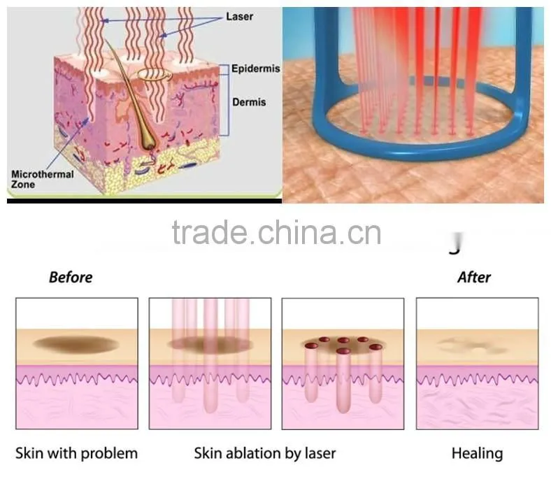laser facial rejuvenation machine / stretch mark removal beauty machine / multifunction facial beauty machine