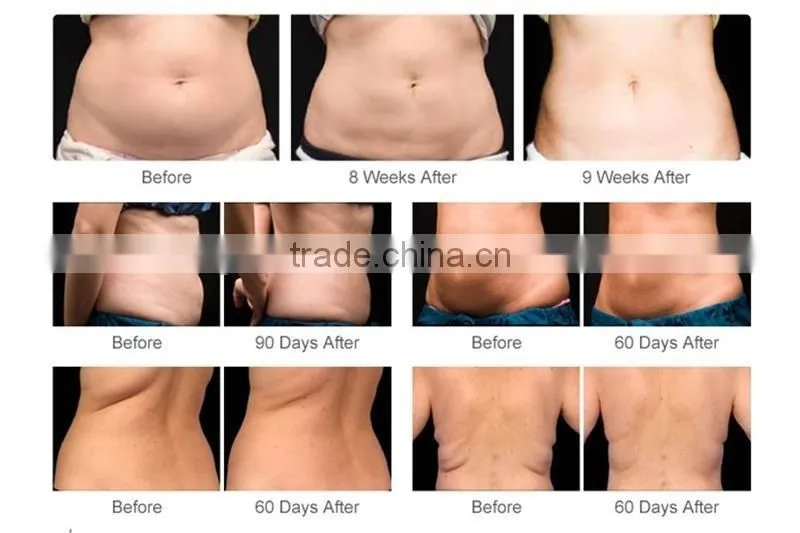 vacuum cellulite removal fat freeze weight loss slimming beauty machine price sale weight loss slimming
