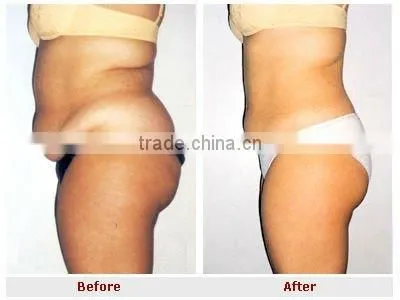 ultrasound liposuction rf tripolar reduce belly equipment F017