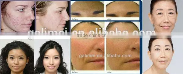 Multipolar RF 6 in 1 cavitation laser slimming machine/fast cavitation slimming system