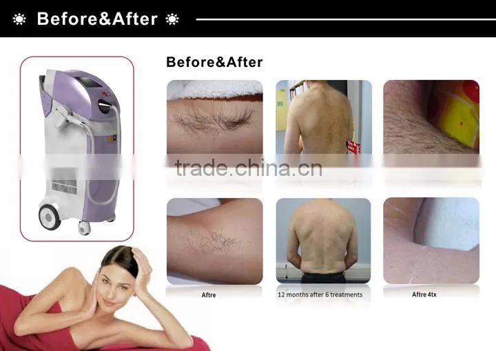 808 Diode Laser Depilatory / Laser Permanent Hair Removal