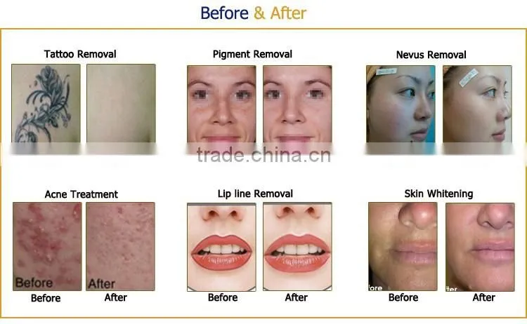 PicoSecond laser new laser for tattoo removal pigment removal