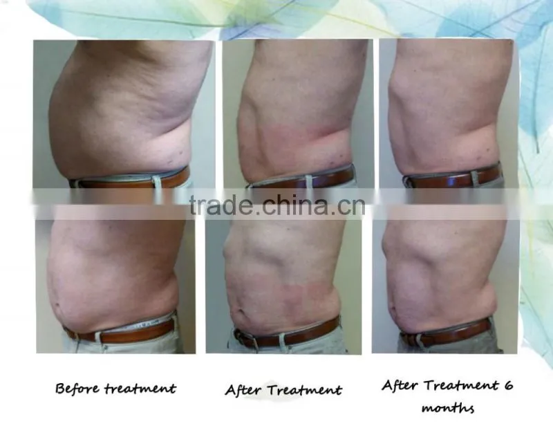 Cryotherapy g5 vibrating cellulite massage machine