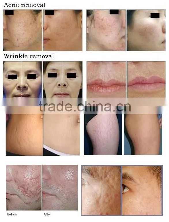Newest CO2 laser machine laser co2 fractional,fractional co2 laser equipment,co2 laser