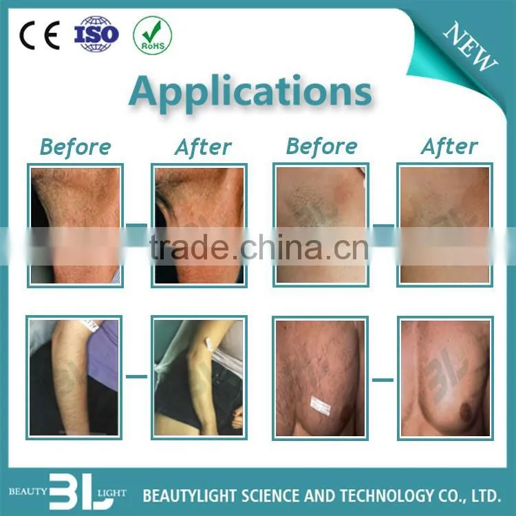 lightsheer diode laser system, laser hair removal best machines, hair laser