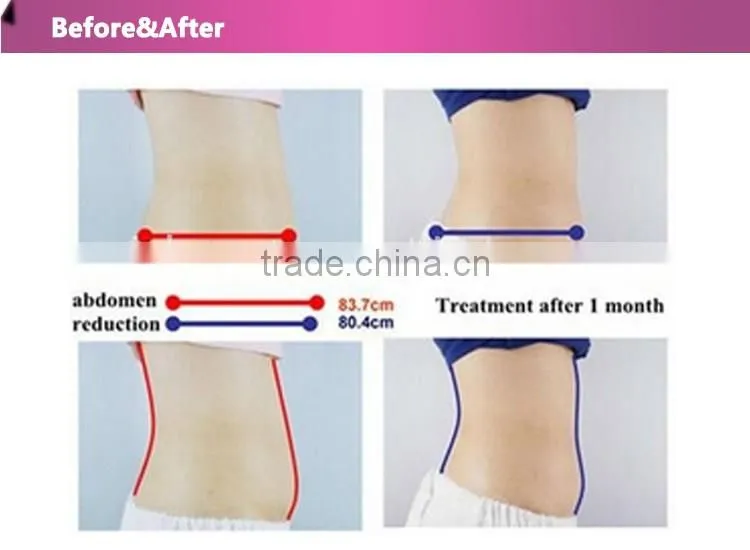 ultrasonic liposuction machine/non-invasive liposuction machine