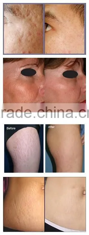 CO2 fractional laser acne and acne scar removal device