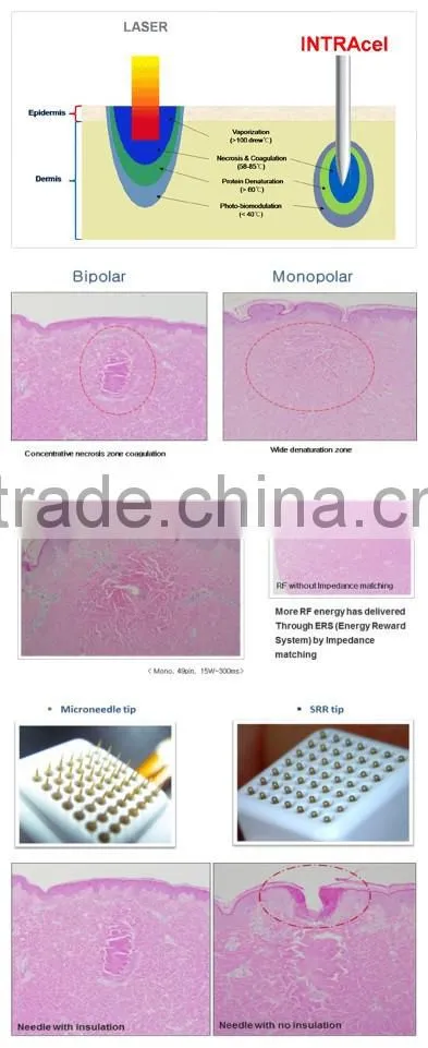 Manufacturer supply 2Mhz 50w portable wrinkle removal fractional rf machine