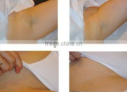 Long pulse ND yag epilation laser permanent laser hair removal/tatoo removal machine for beauty salon