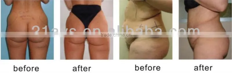 Slimming RF Laser Cavitation Liposuction Vacumm Magic Polar Beauty Equipment