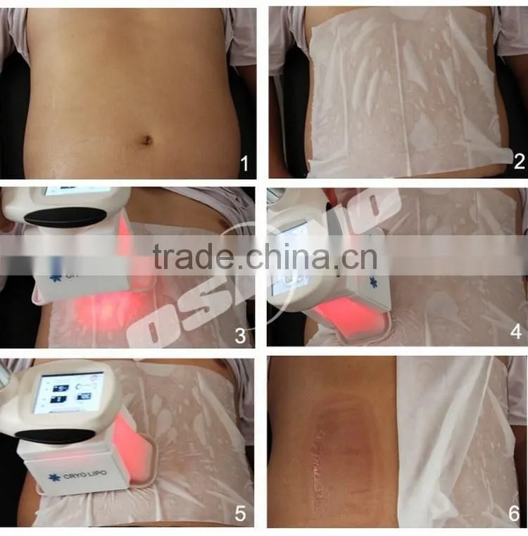 Criolipolise Weight Loss Beauty Slimming Instrument For Sale