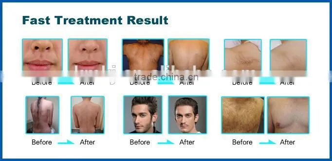 Big promotion shr laser hair removal machine with best price