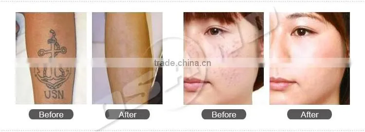 Yag Laser Machine Freckle Removal Permanent Tatto Remover Laser