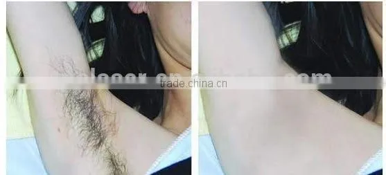 body hair removal for men and women alexandrite laser 755nm machine