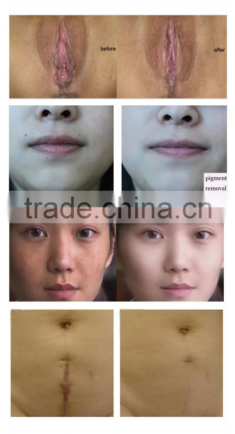 fractional co2 laser machine for Genitals Beauty hot selling