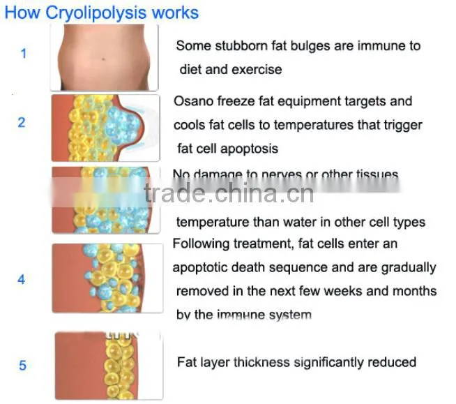 Best products cryolipolysis cool shape machine/portable cryolipolysis machine beco