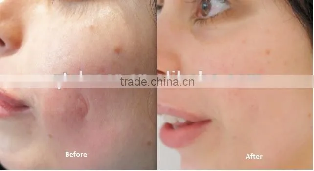 CO2 fractional laser for scanning,cutting,vagina tightening machine