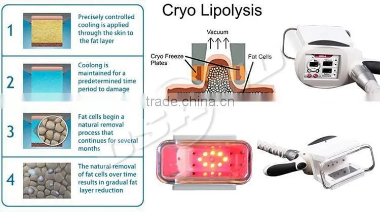 Hot Sale Cryotherapy Vacuum Criolipolisis machine radiofrequence