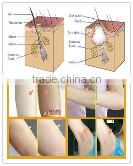 Best effective mini ipl/rf hair removal machine portable with most advanced technology