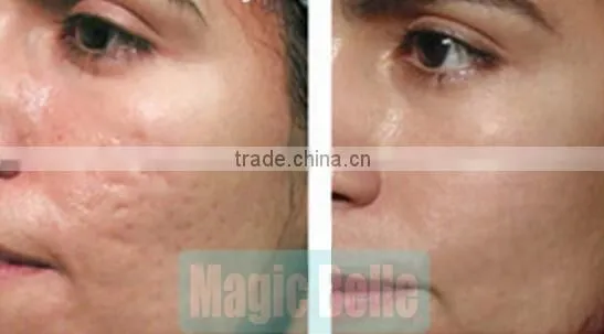 CE Certificated hydro facial dermabrasion spa equipment scrubber machine Hydrodermabrasion in alibaba