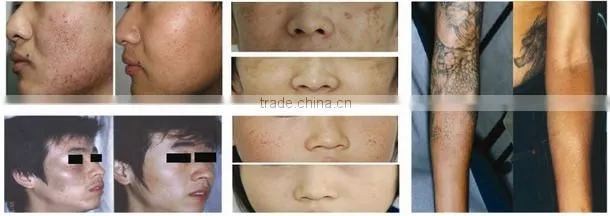 tattoo removal machine, Q switch nd yag laser, laser tattoo removal, nd yag laser tatoo removal