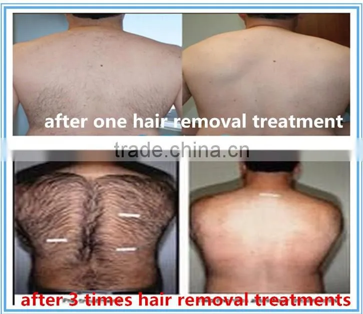 2016 professional diode laser 808nm laser hair removal machine for sale