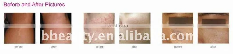 tattoo removal laser equipment