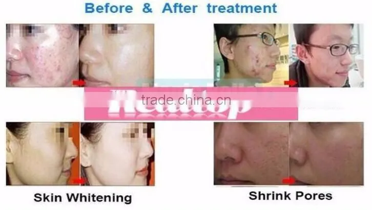 2 in1 Mini Diamond Microdermabrason machine Peeling Dermabrasion Skin Care Spa Device Peeling Device Clean Pore