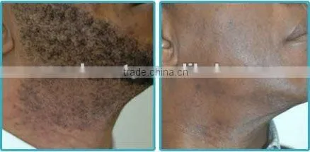yag laser therapy nano hair removal P001