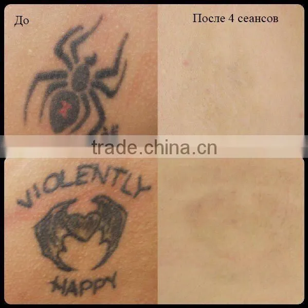 Ce And Fda Approval best 532 & 1064nm q-switched nd yag laser tattoo removal machine price