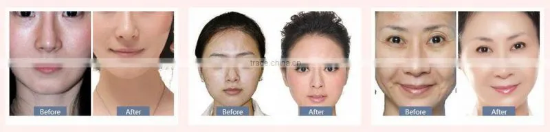 2016 newest patent design hot and cold facial hammer