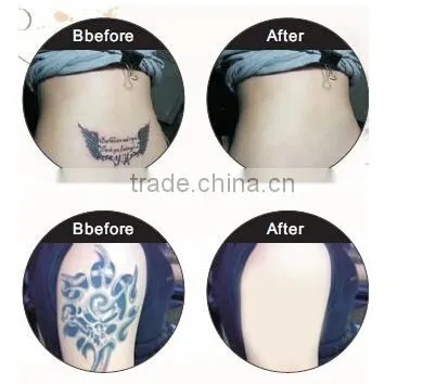 Economic Salon and Home Use Beauty Machine Portable IPL Laser Hair Removal Machine Price