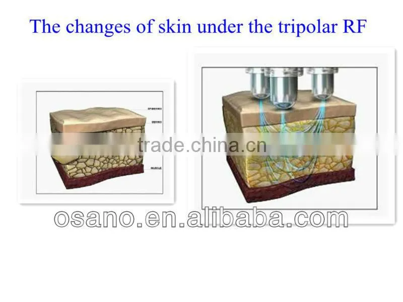 ultrasonic laser face lift machine home use