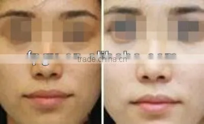 The Latest Portable E-light and RF Beauty Machine