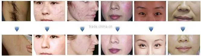 Aispirit combination machine YAG laser removal pigment and SHR handle for fast hair removal