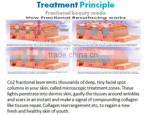 GGLT RF tube CO2 fractional laser vaginal tightening Skin rejuvenation machine price