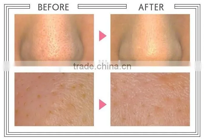 LCD ultrasonic skin scrubber LW-006 skin cleaner