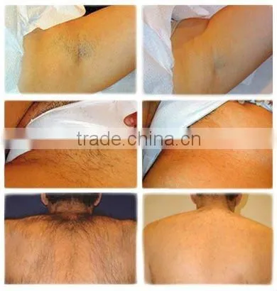 2016 new elight skin tightening hair removal machine Sales promotion C008