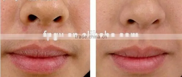 Shr ipl hair removal skin rejuvenation IPL