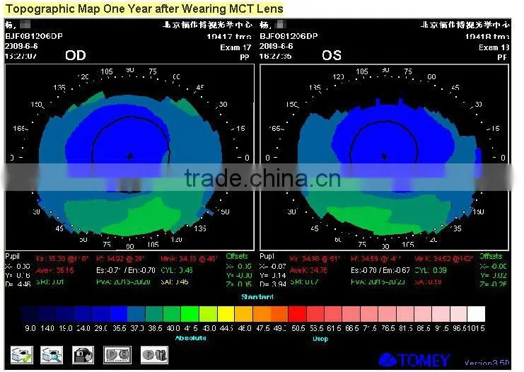 After Laser Surgery/MCT-L/High-end MCT Technology improve of OK Lenses