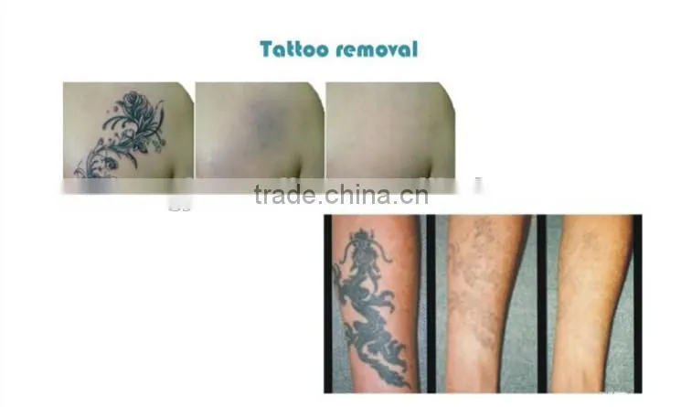 Easy work professional Portable yag laser tattoo