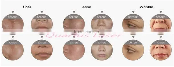 RF tube co2 fractional laser