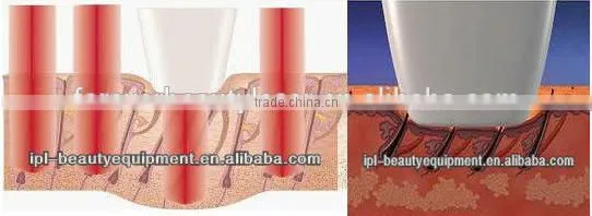 808 Diode Laser Depilatory / Laser Permanent Hair Removal
