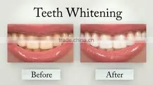 Revolutionary Teeth Whitening Kit Names of Dental Instruments Dental Supply TOOTH CARE
