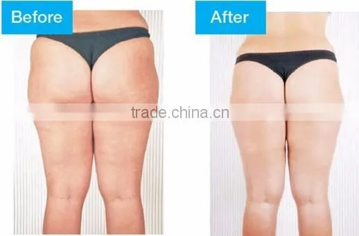 Super Slimming Fat Dissolving lipolaser/diode laser/slimming machine